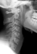 Cervical spine curve and chiropractic